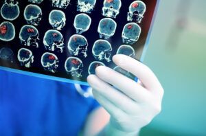 What is a brain injury?